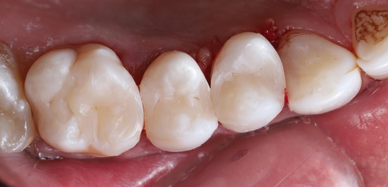 After — Decay removed and teeth restored with tooth-coloured fillings