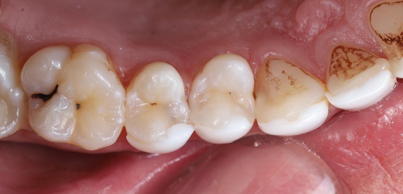 Before — Decay removed and teeth restored with tooth-coloured fillings
