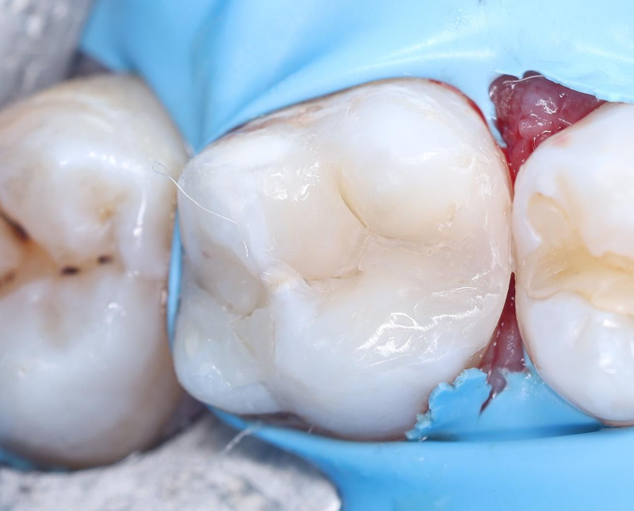After — Old metal filling replaced with a tooth-coloured restoration