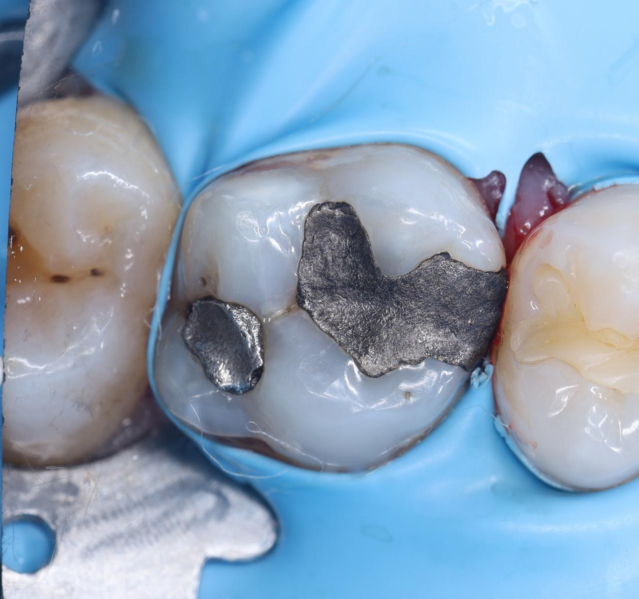 Before — Old metal filling replaced with a tooth-coloured restoration