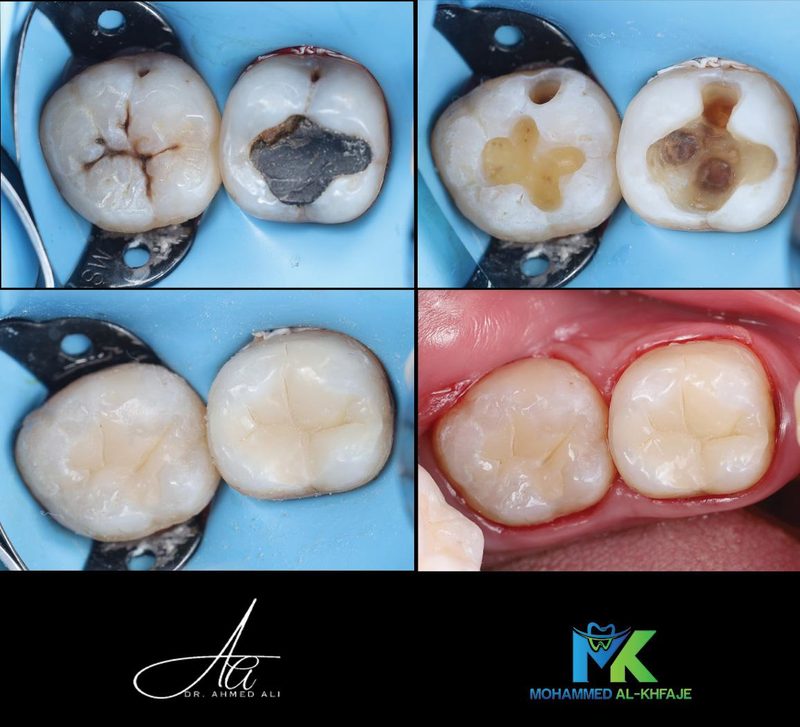 Decayed back teeth restored with tooth-coloured fillings, step by step