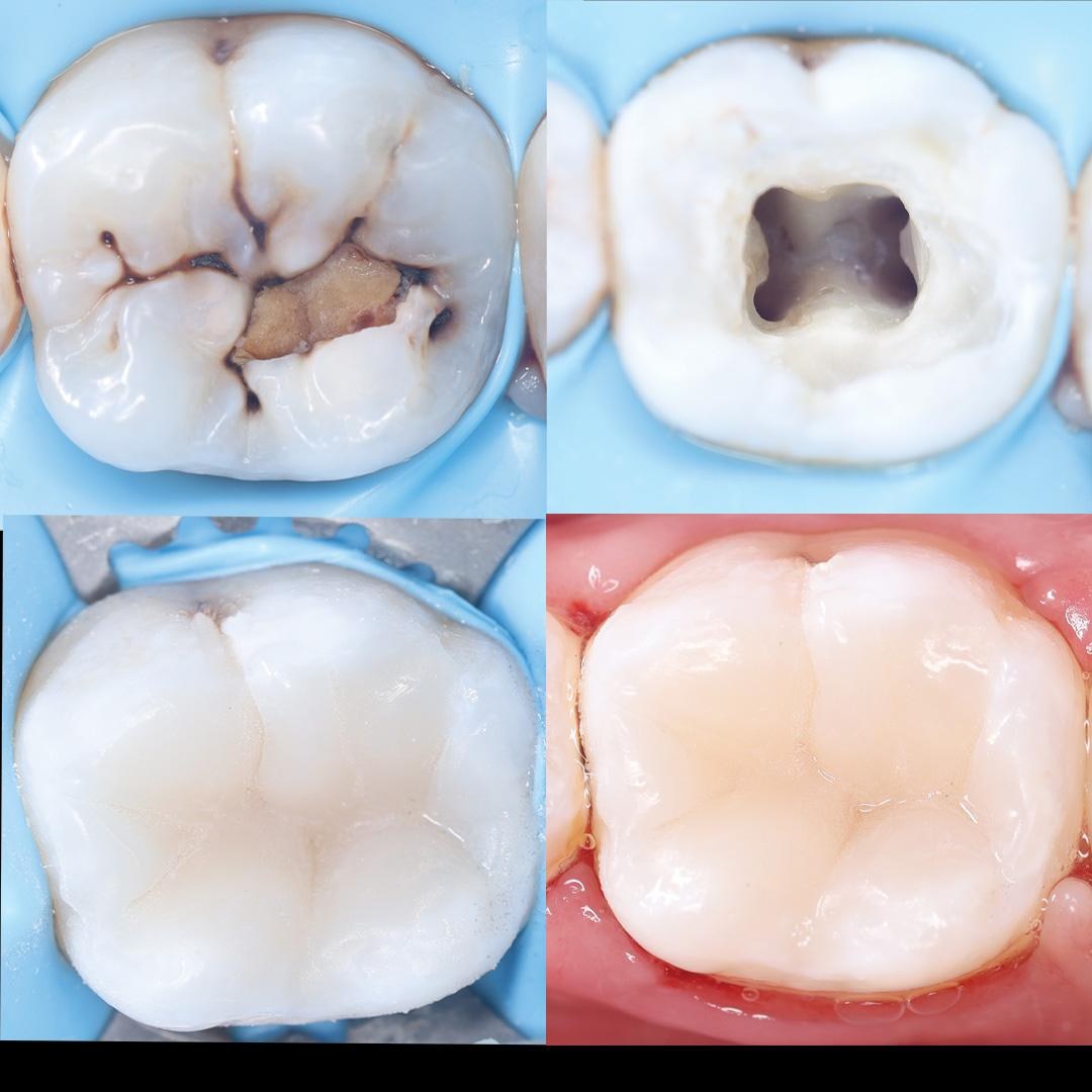 Deep decay removed and the tooth restored with a tooth-coloured filling