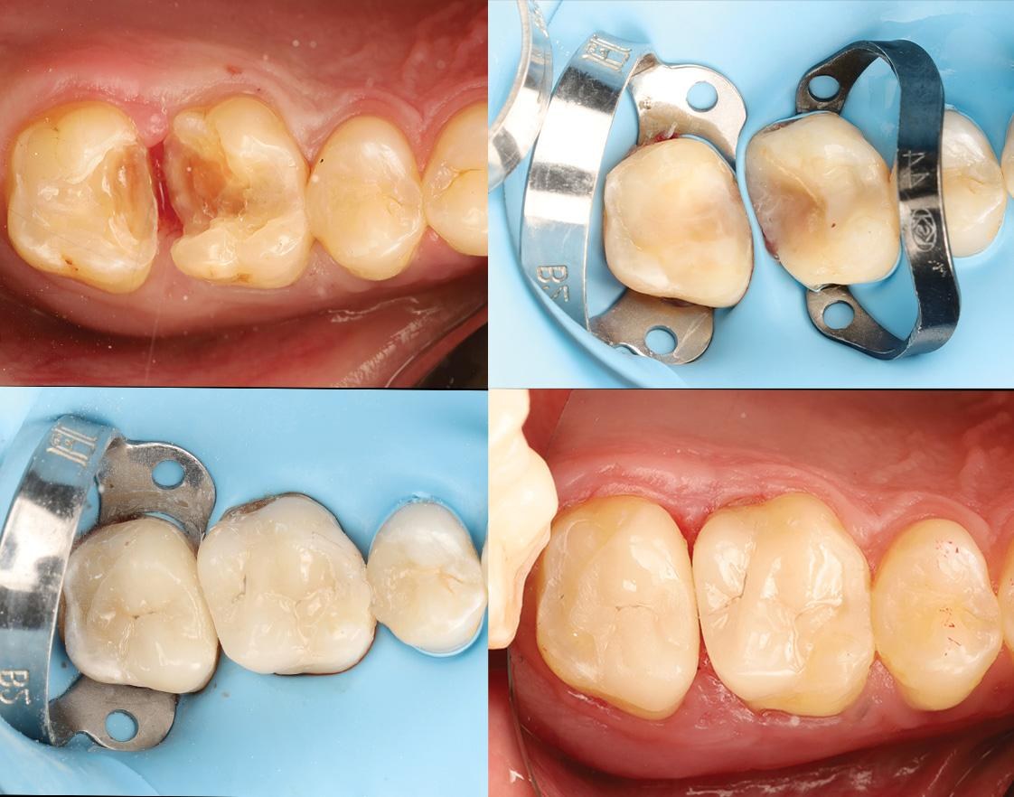 Damaged teeth rebuilt with tooth-coloured restorations