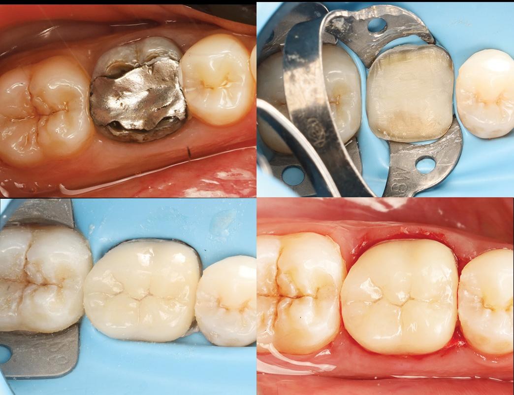 Old metal restoration replaced with a tooth-coloured one