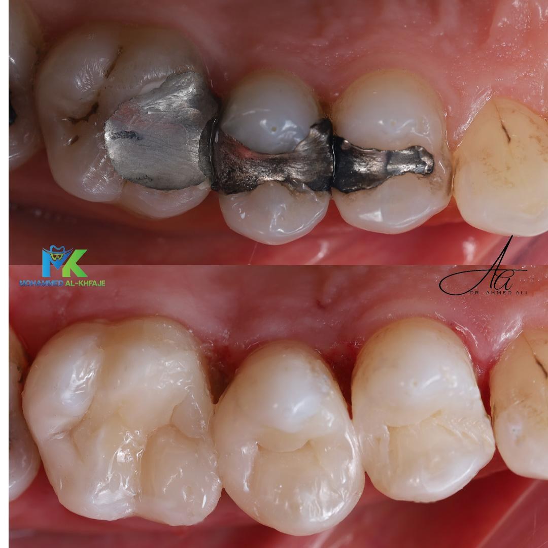 Old metal fillings replaced with tooth-coloured restorations