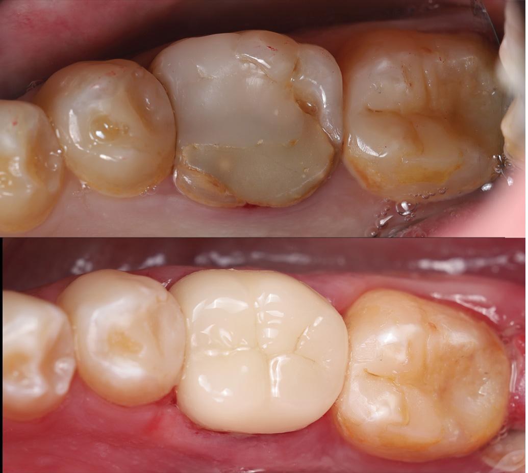 Old restoration replaced with a new tooth-coloured one