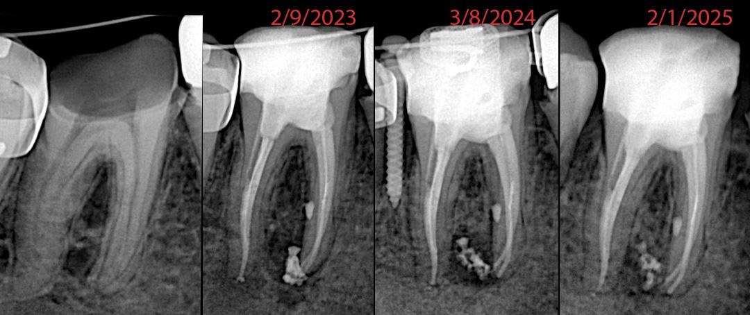 Root canal treatment, with follow-up X-rays from 2023 to 2025