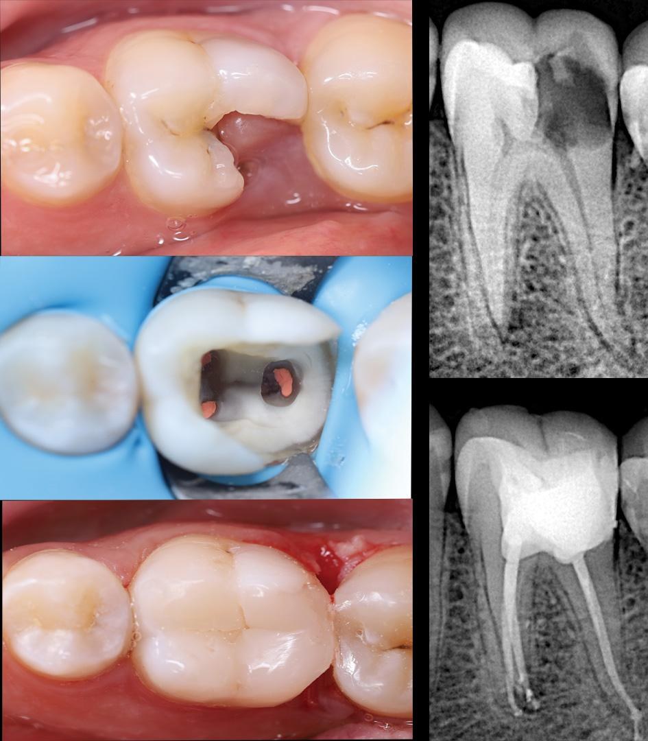 Root canal treatment and rebuilding of a broken molar