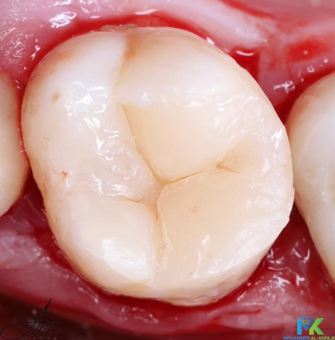 After — Root canal treatment followed by a tooth-coloured restoration