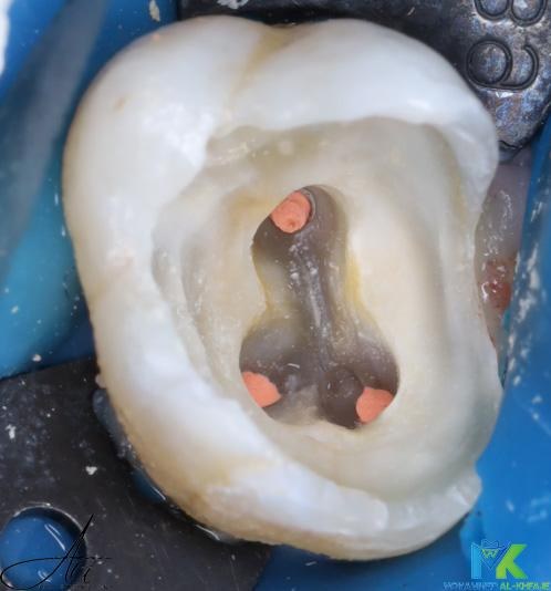 Before — Root canal treatment followed by a tooth-coloured restoration
