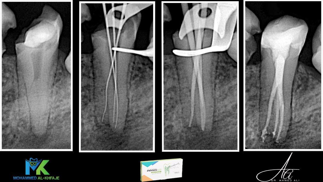 Root canal treatment