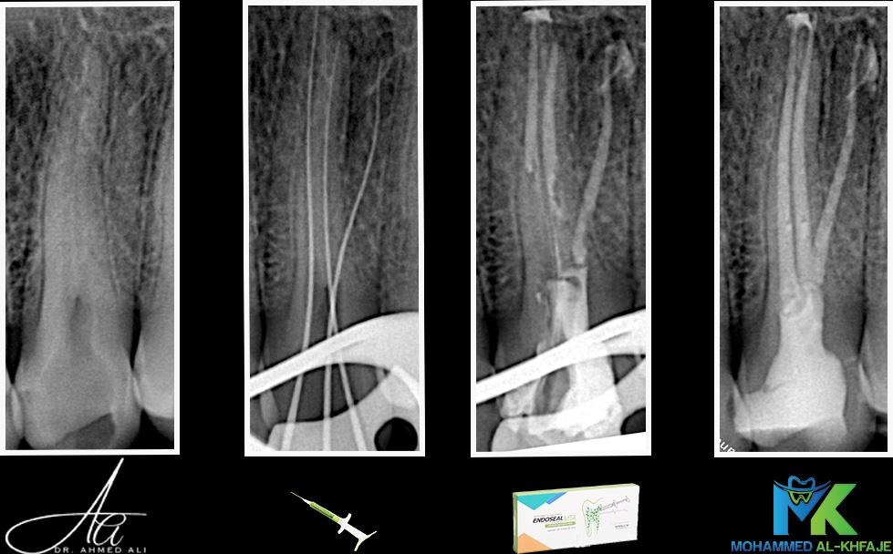 Root canal treatment