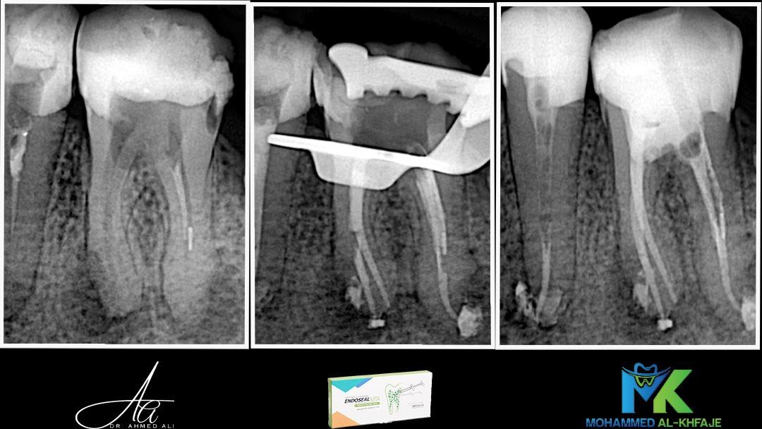 Root canal treatment