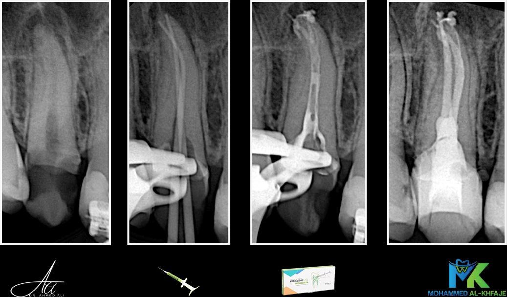 Root canal treatment