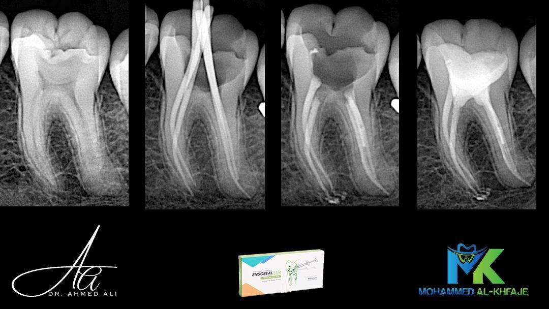 Root canal treatment
