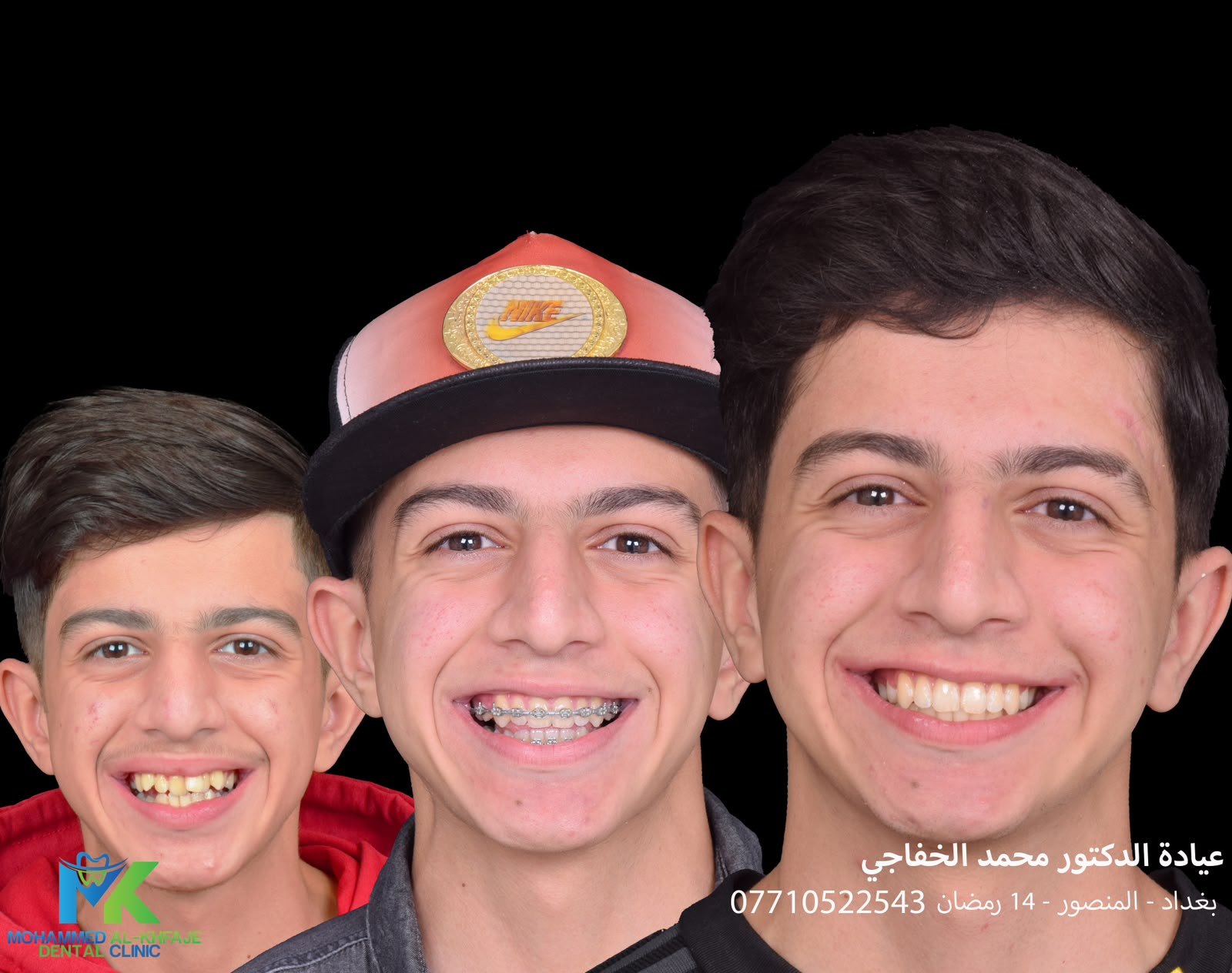 Treatment with fixed braces: before, during and after
