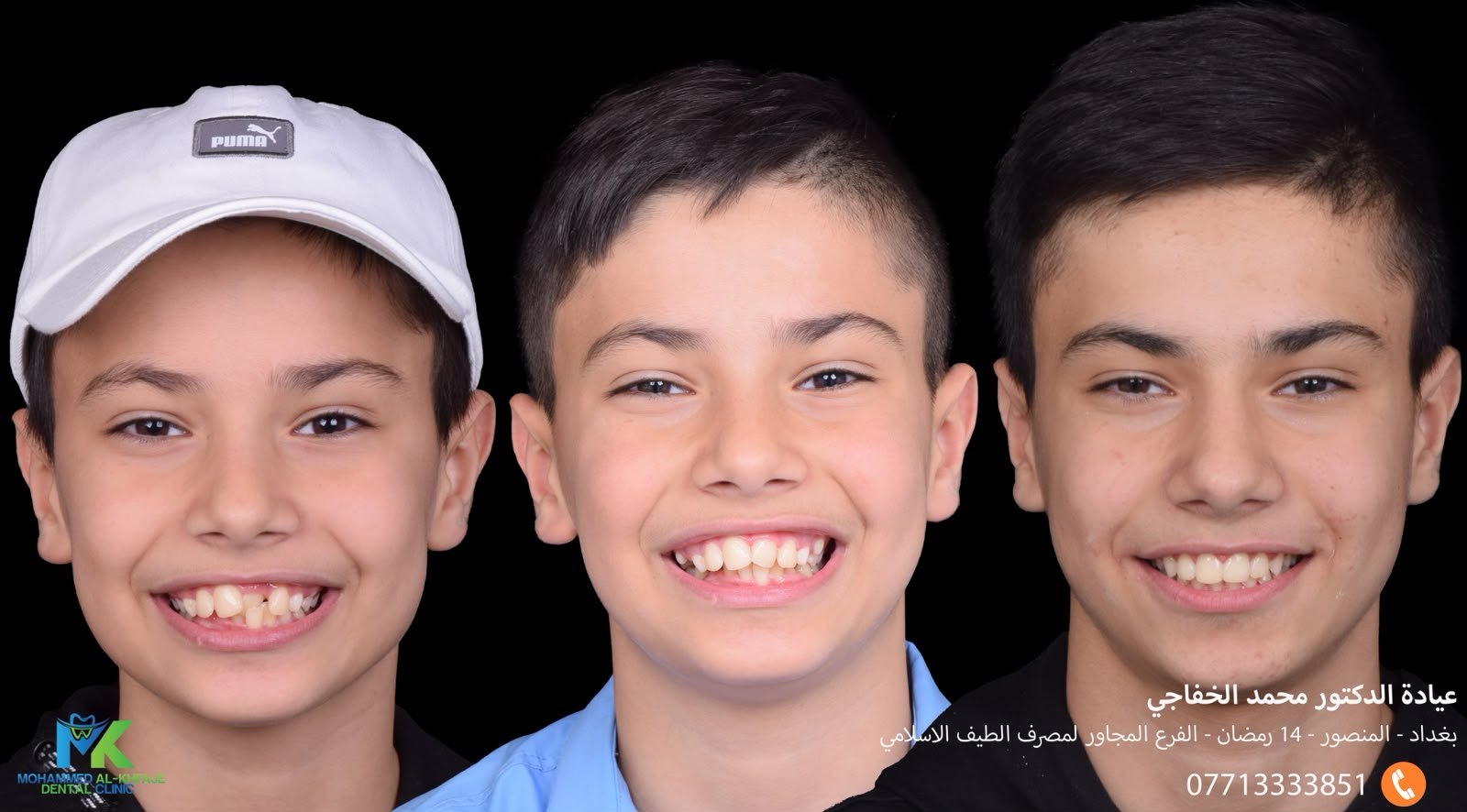 Teeth becoming straighter through the stages of orthodontic treatment