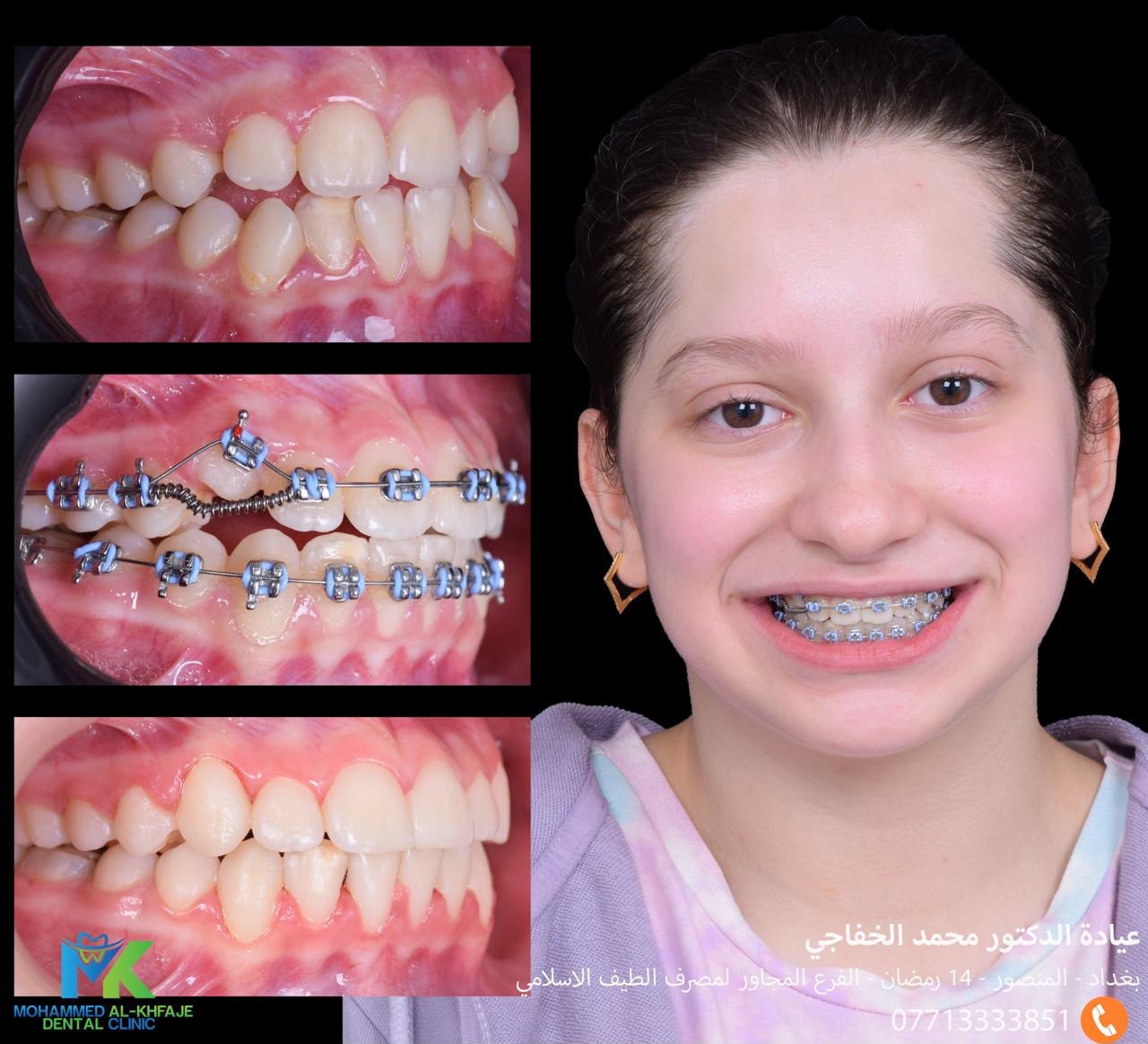 Fixed braces: before, during and after