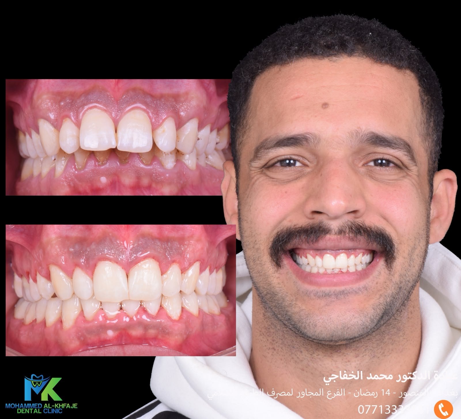 Front teeth aligned and gaps closed
