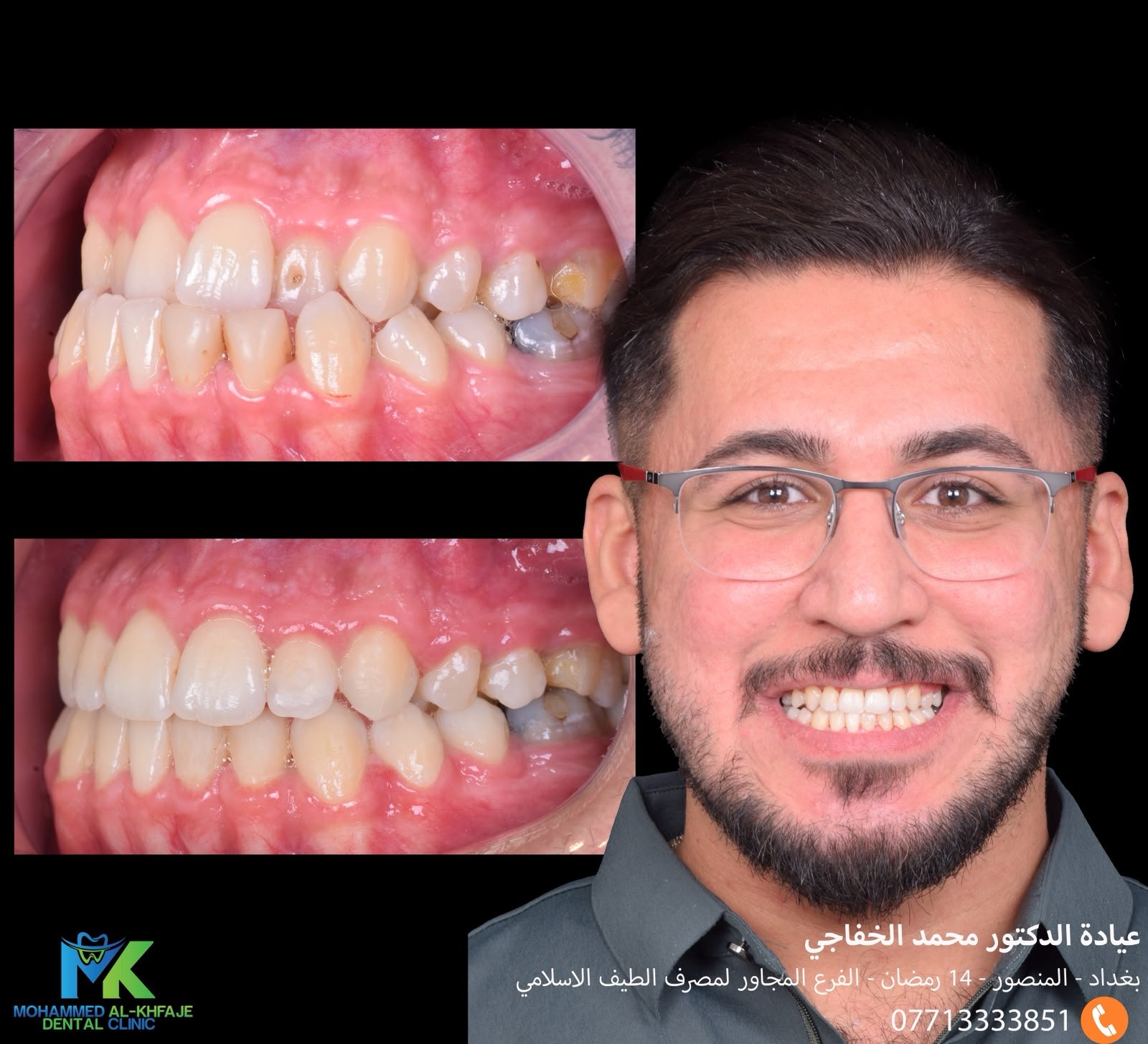 Orthodontic treatment: before and after