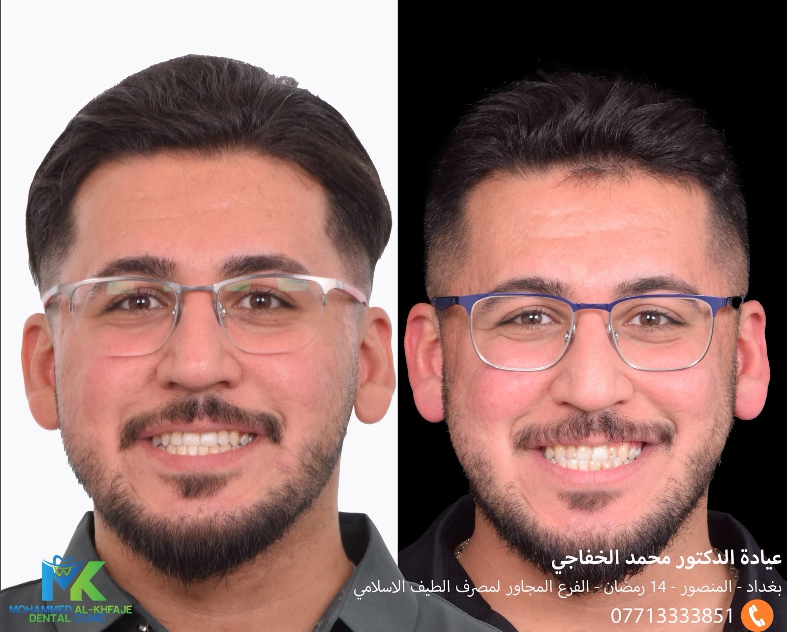 Orthodontic treatment: before and after