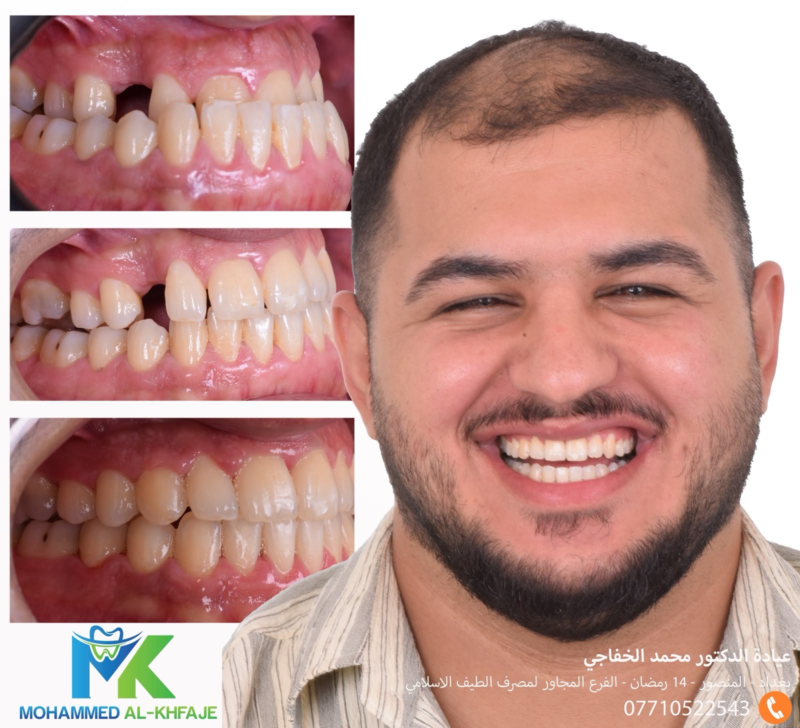Space closed and teeth aligned