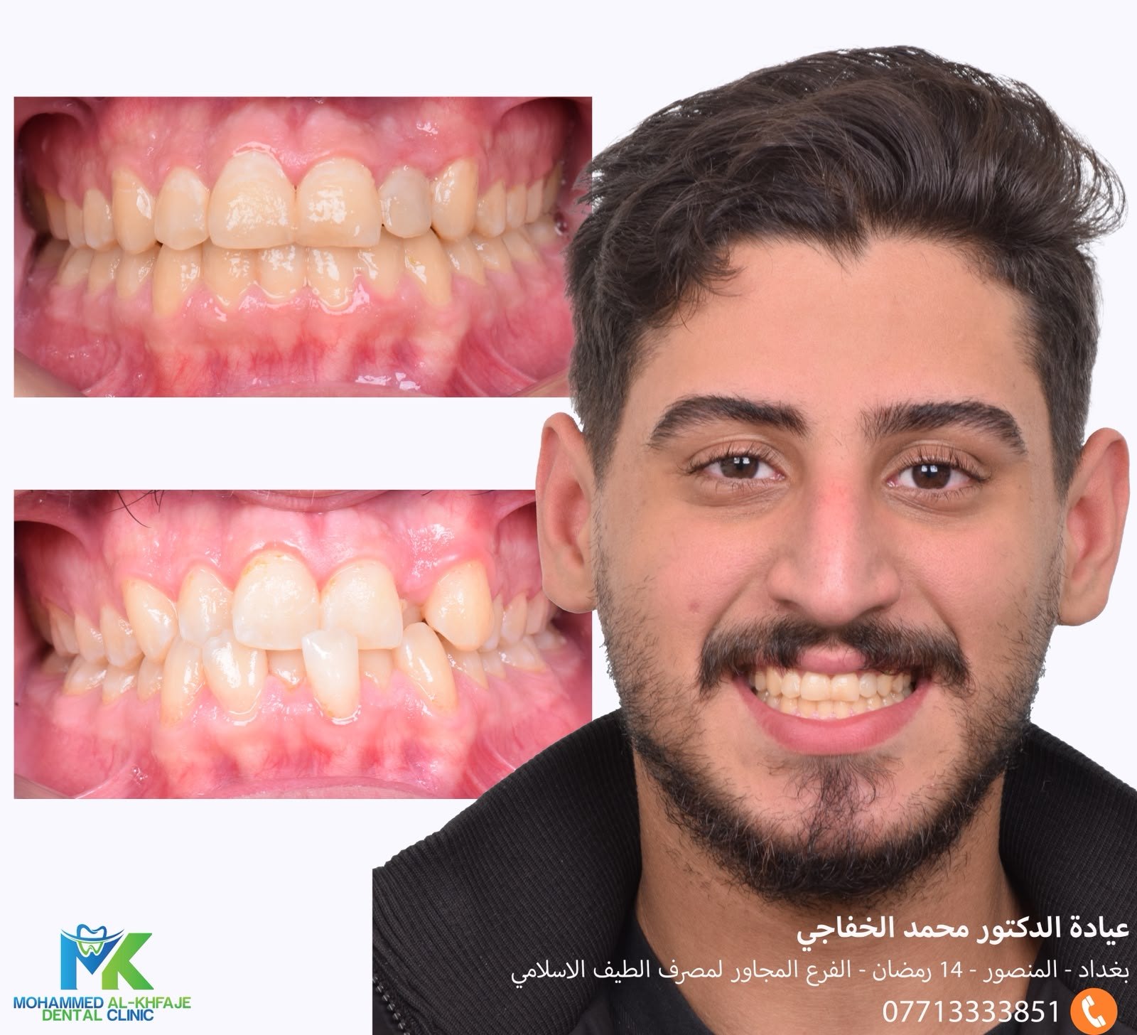 Crowded teeth aligned