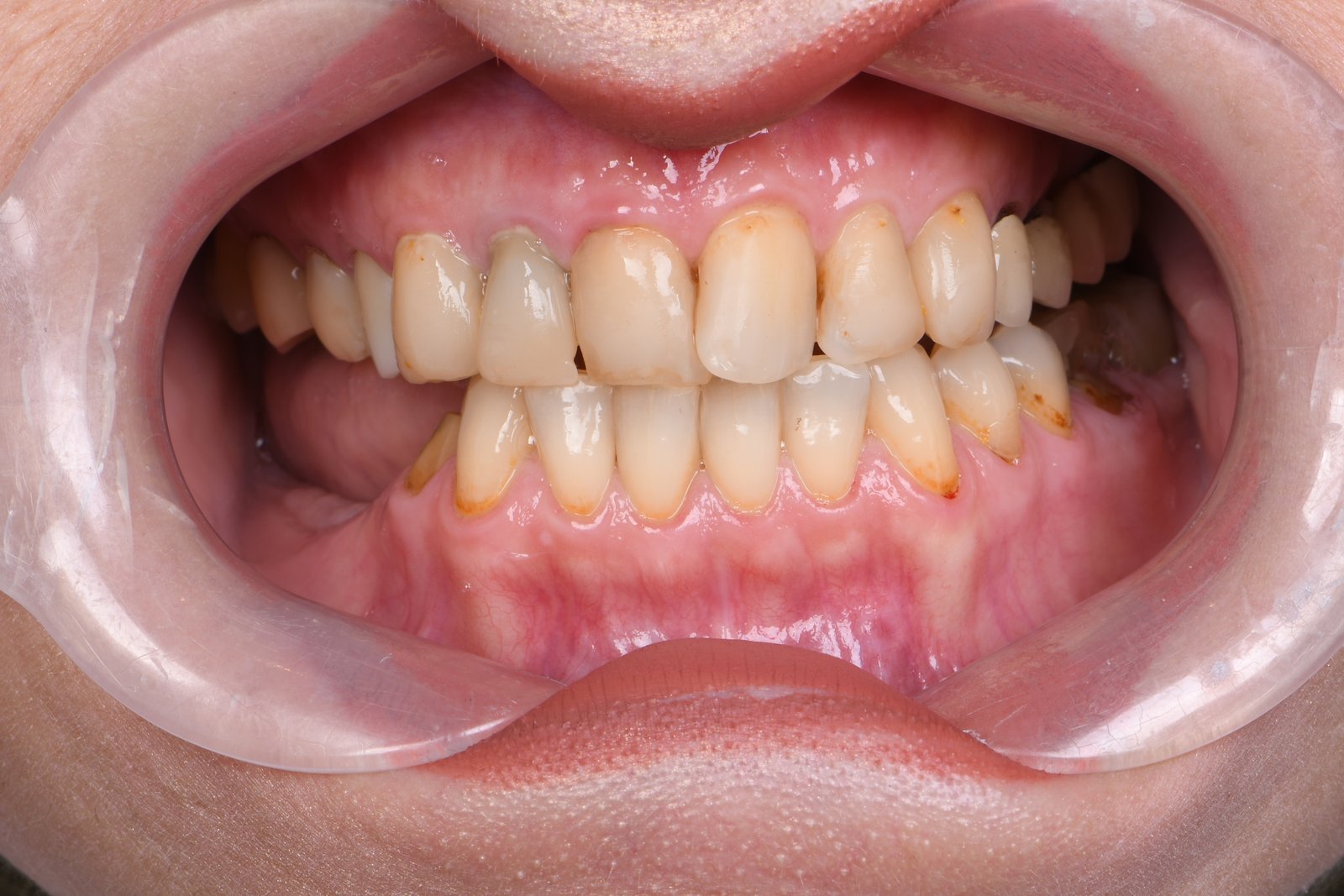 Before treatment — case 1