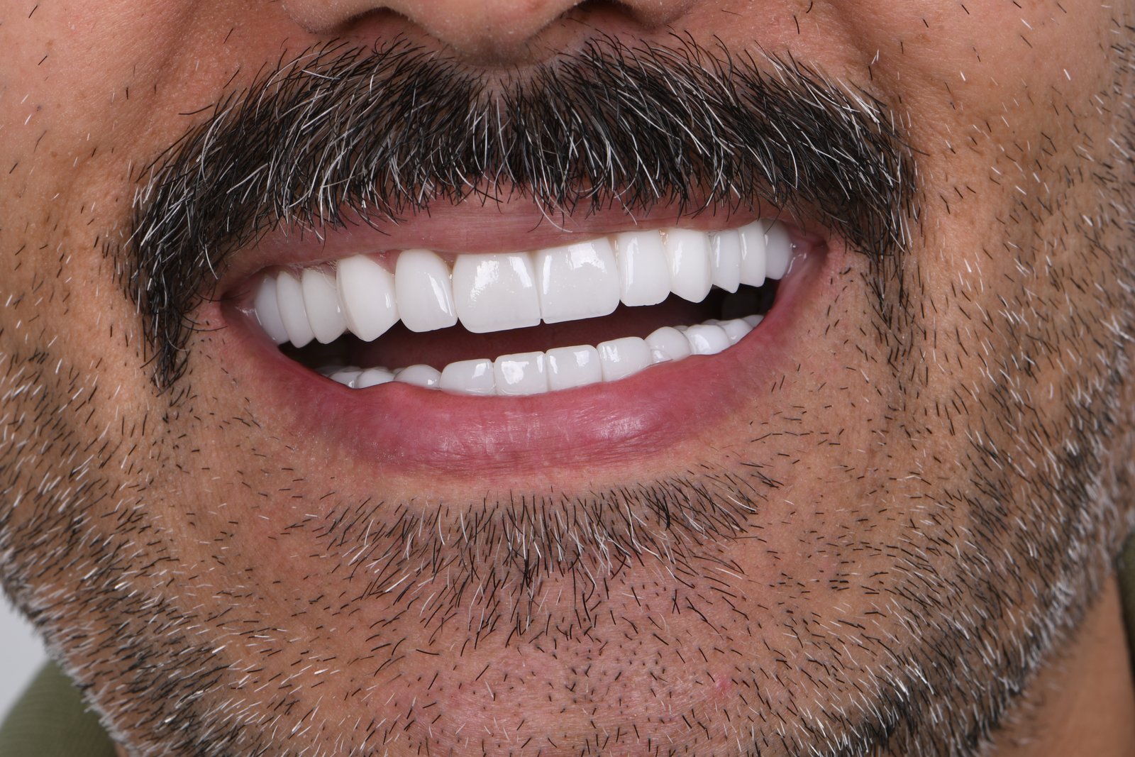 After treatment — case 4