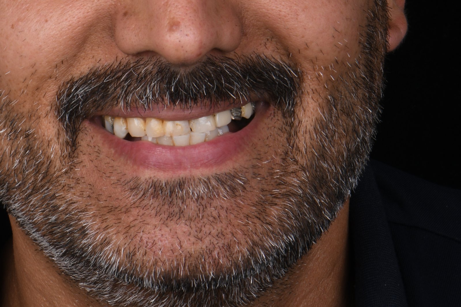 Before treatment — case 4