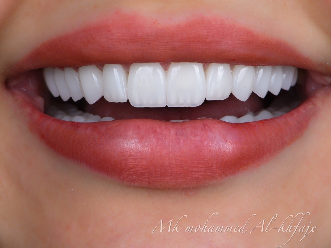 Completed smile — Dr. Mohammed Al-Khfaje