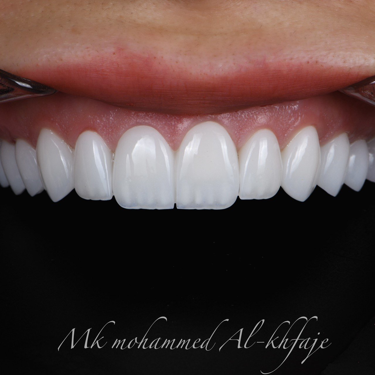 Completed smile — Dr. Mohammed Al-Khfaje