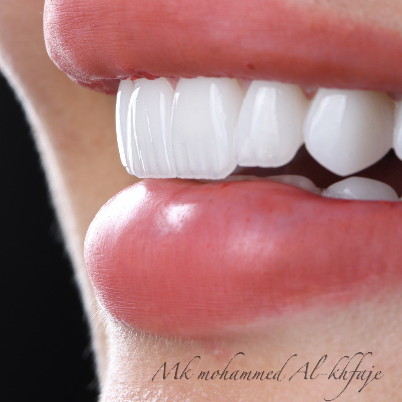 Completed smile — Dr. Mohammed Al-Khfaje