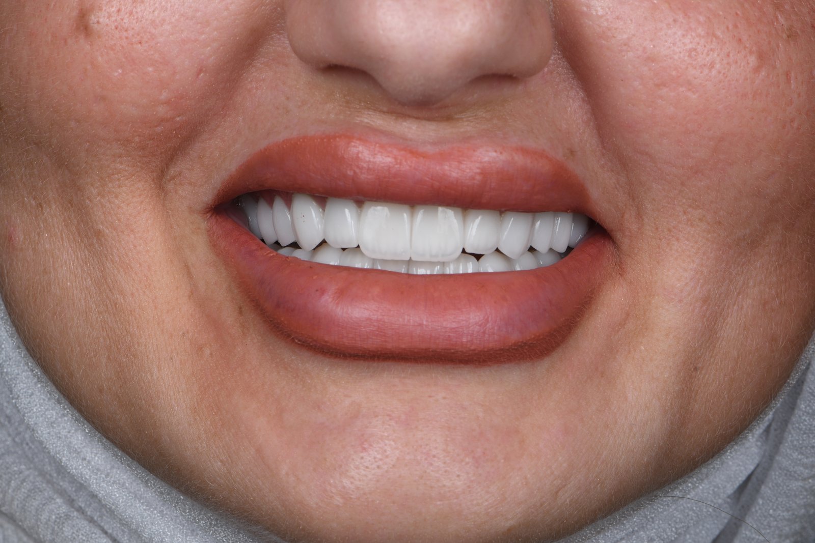 Completed smile — Dr. Mohammed Al-Khfaje