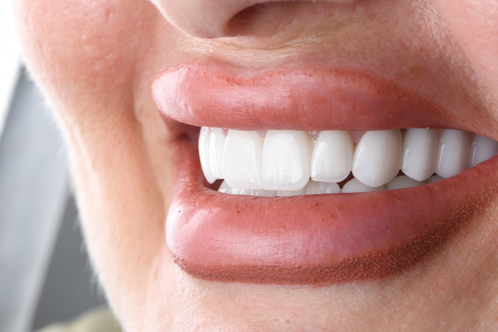 Completed smile — Dr. Mohammed Al-Khfaje