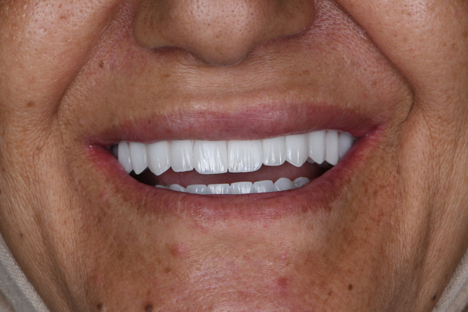 Completed smile — Dr. Mohammed Al-Khfaje
