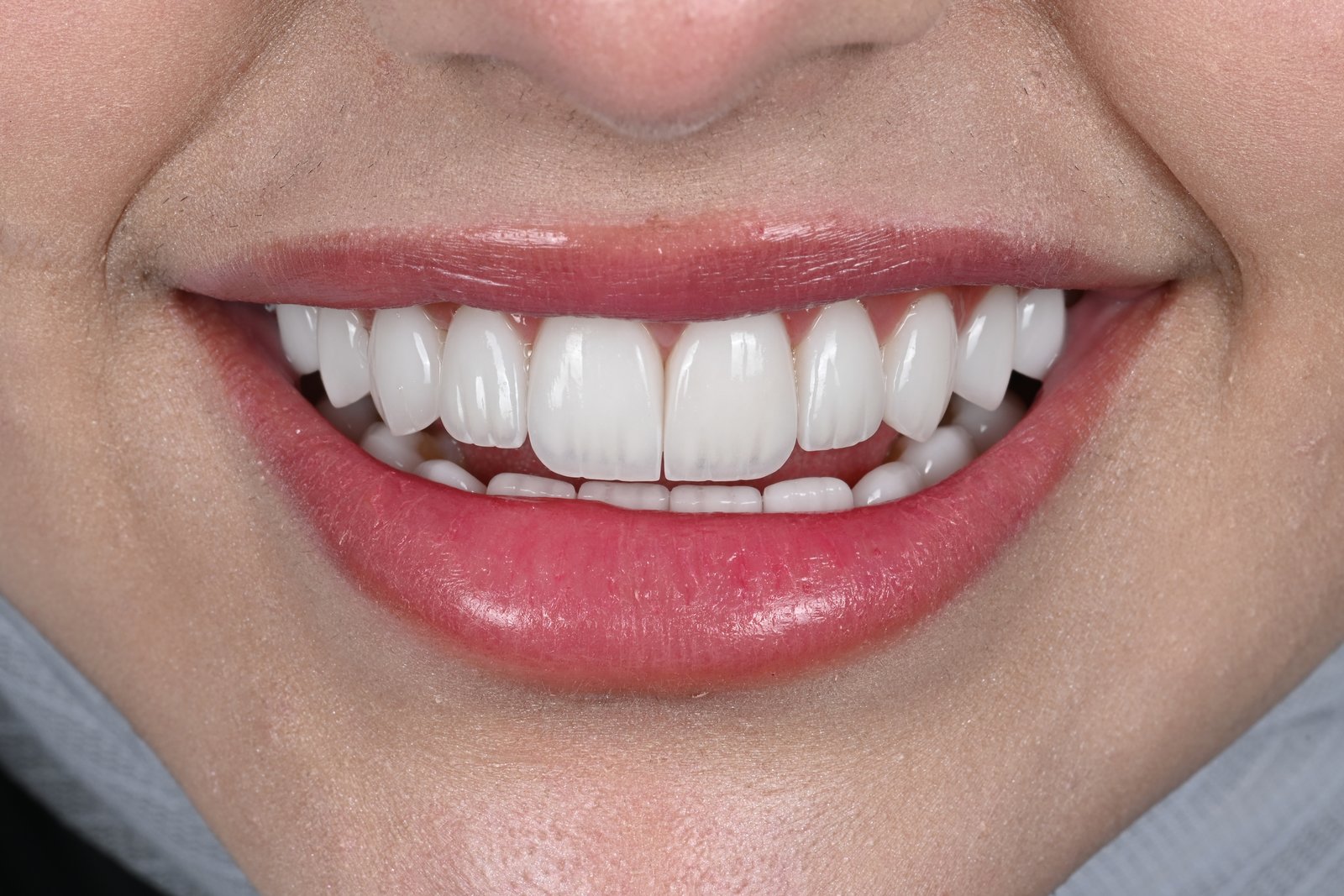 After treatment — case 5