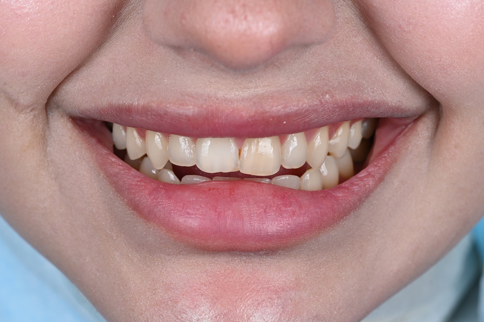 Before treatment — case 5