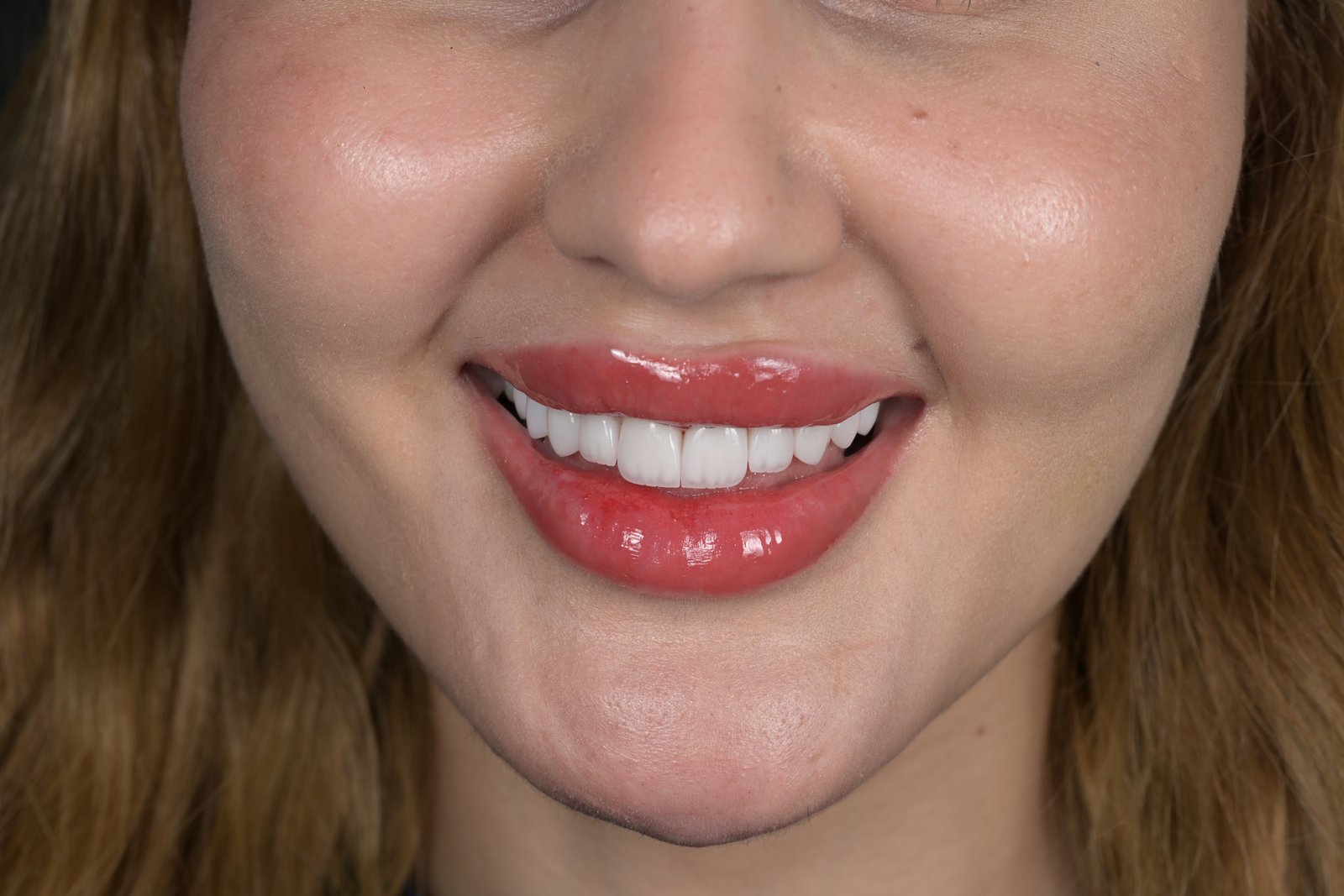 After treatment — case 6