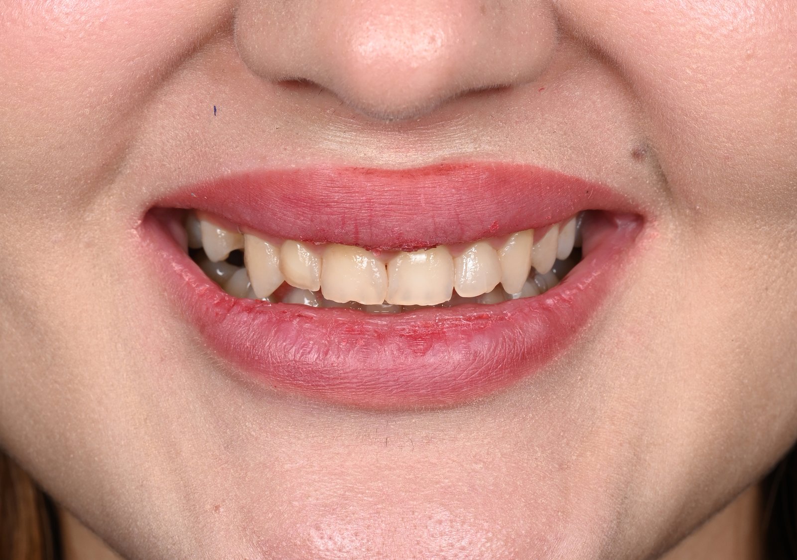Before treatment — case 6
