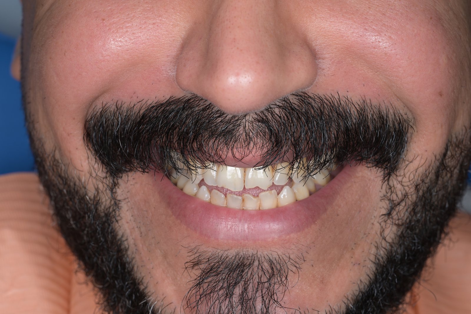 Before treatment — case 10
