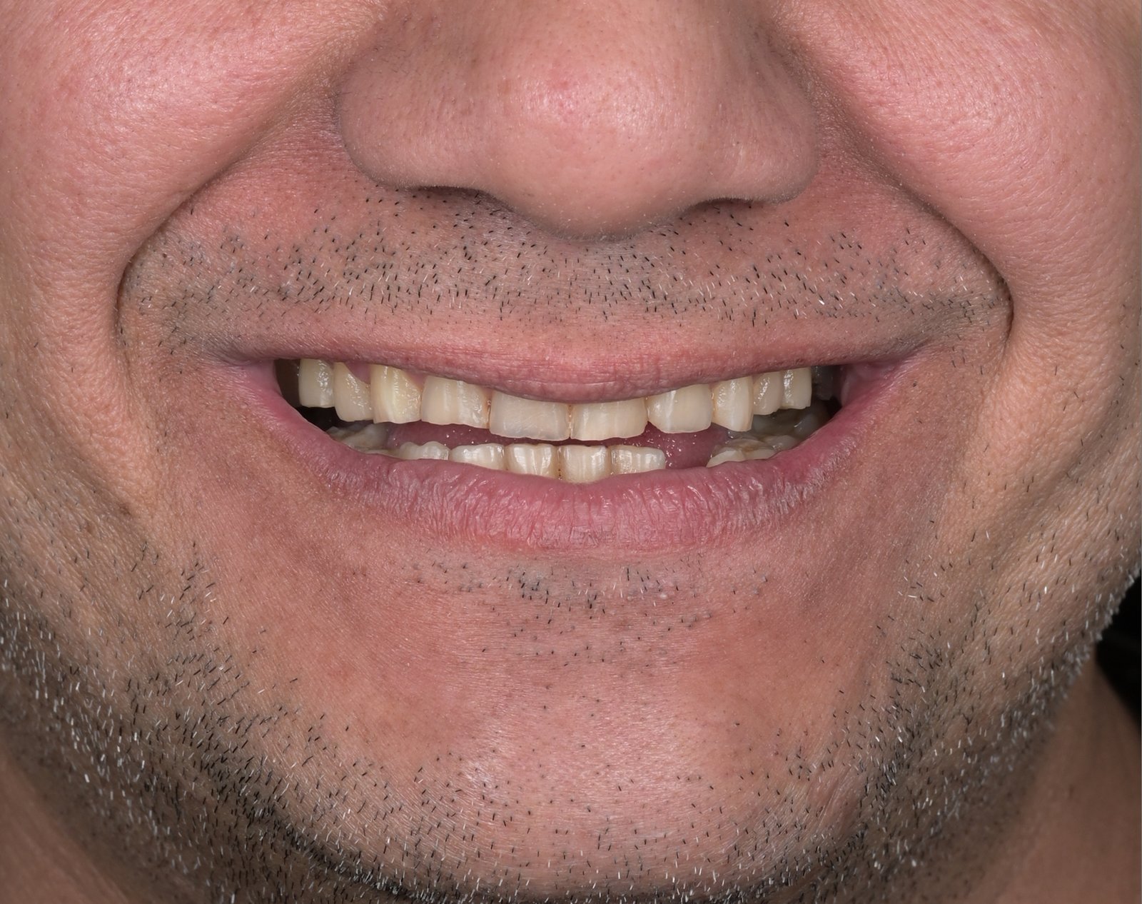 Before treatment — case 11