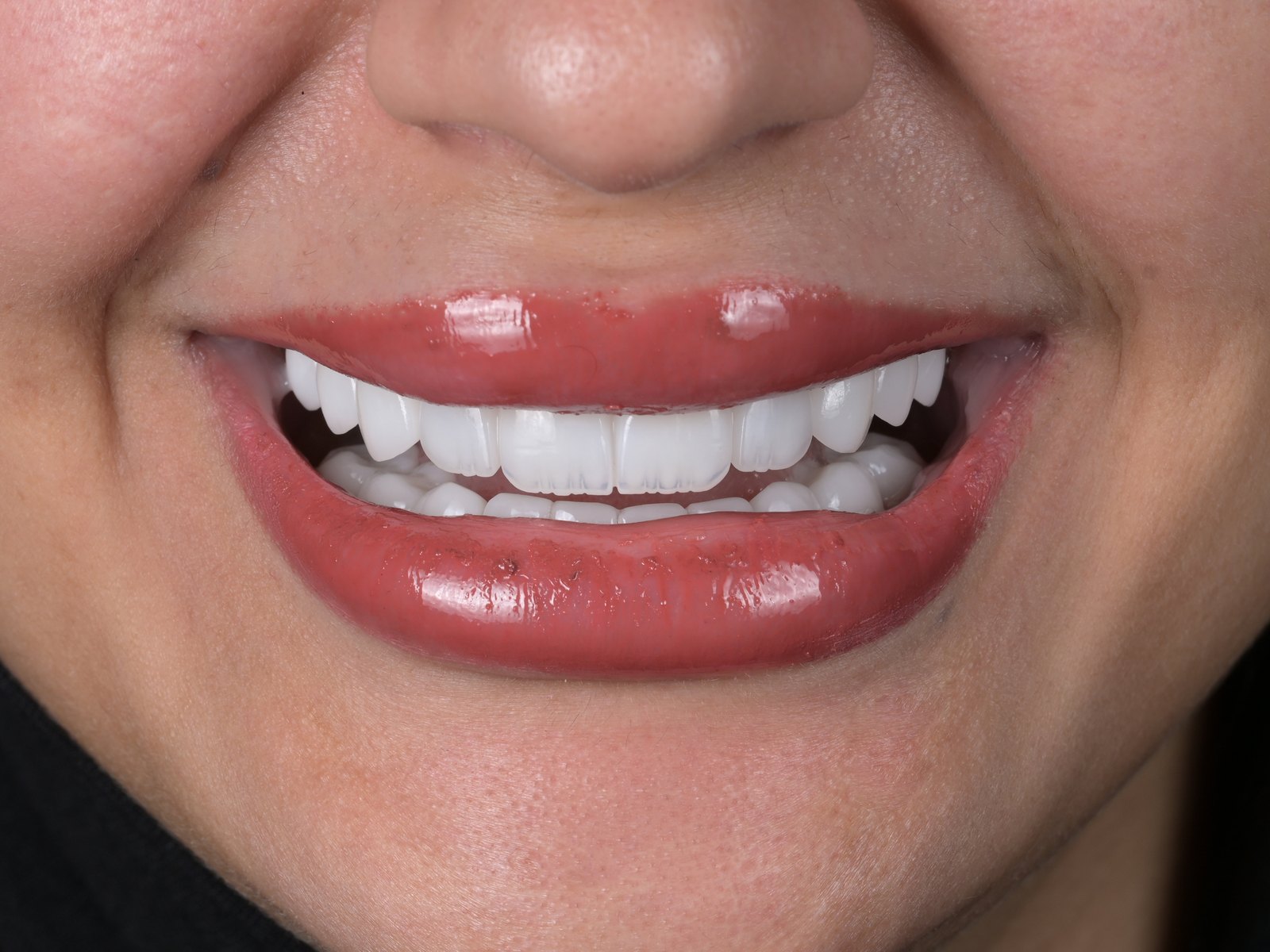 Smile makeover with E.max veneers — after