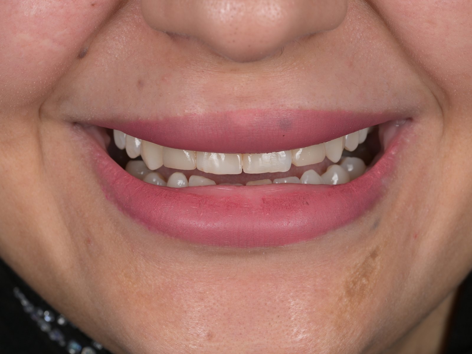 Smile makeover with E.max veneers — before