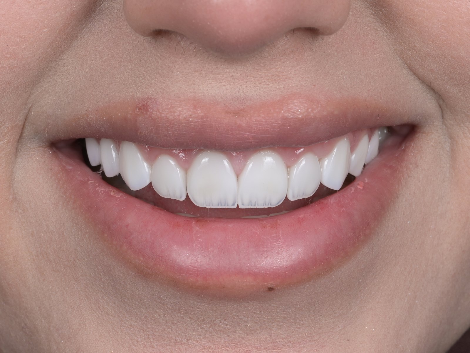 Smile makeover with E.max veneers — after