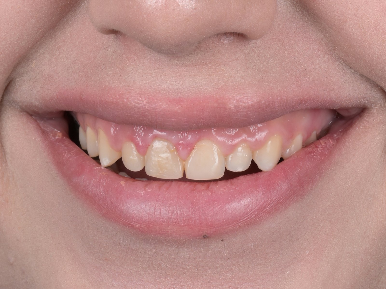 Smile makeover with E.max veneers — before