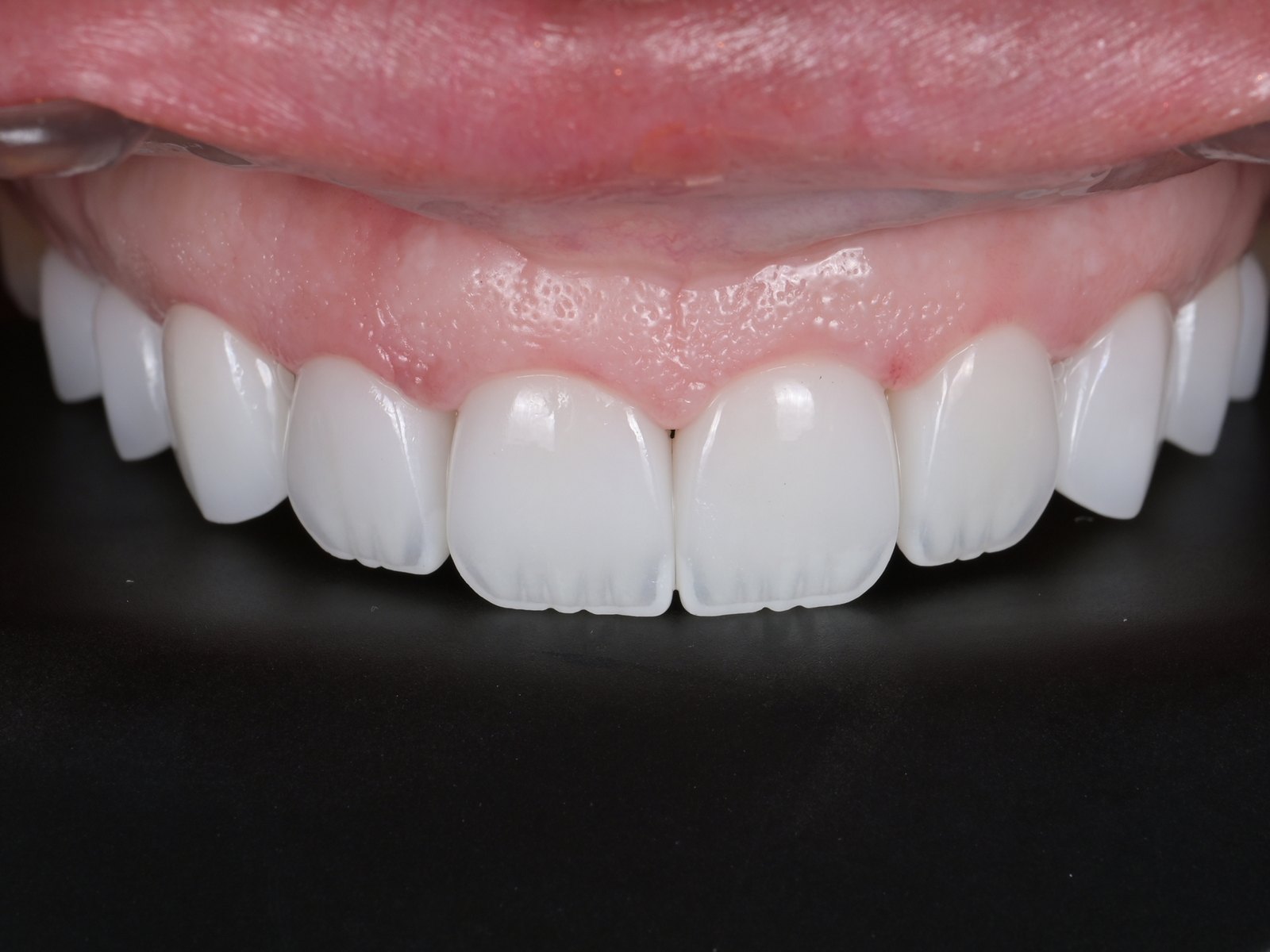 Smile makeover with E.max veneers — after