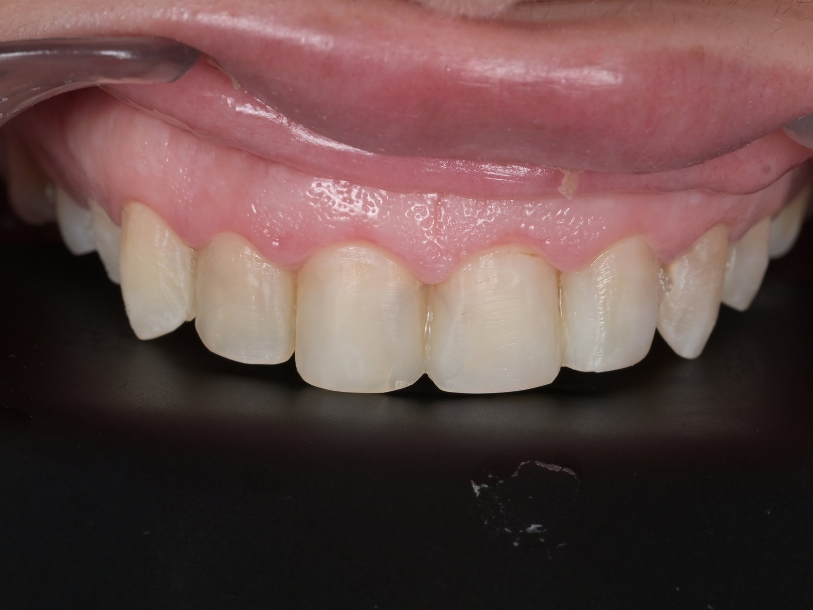 Smile makeover with E.max veneers — before