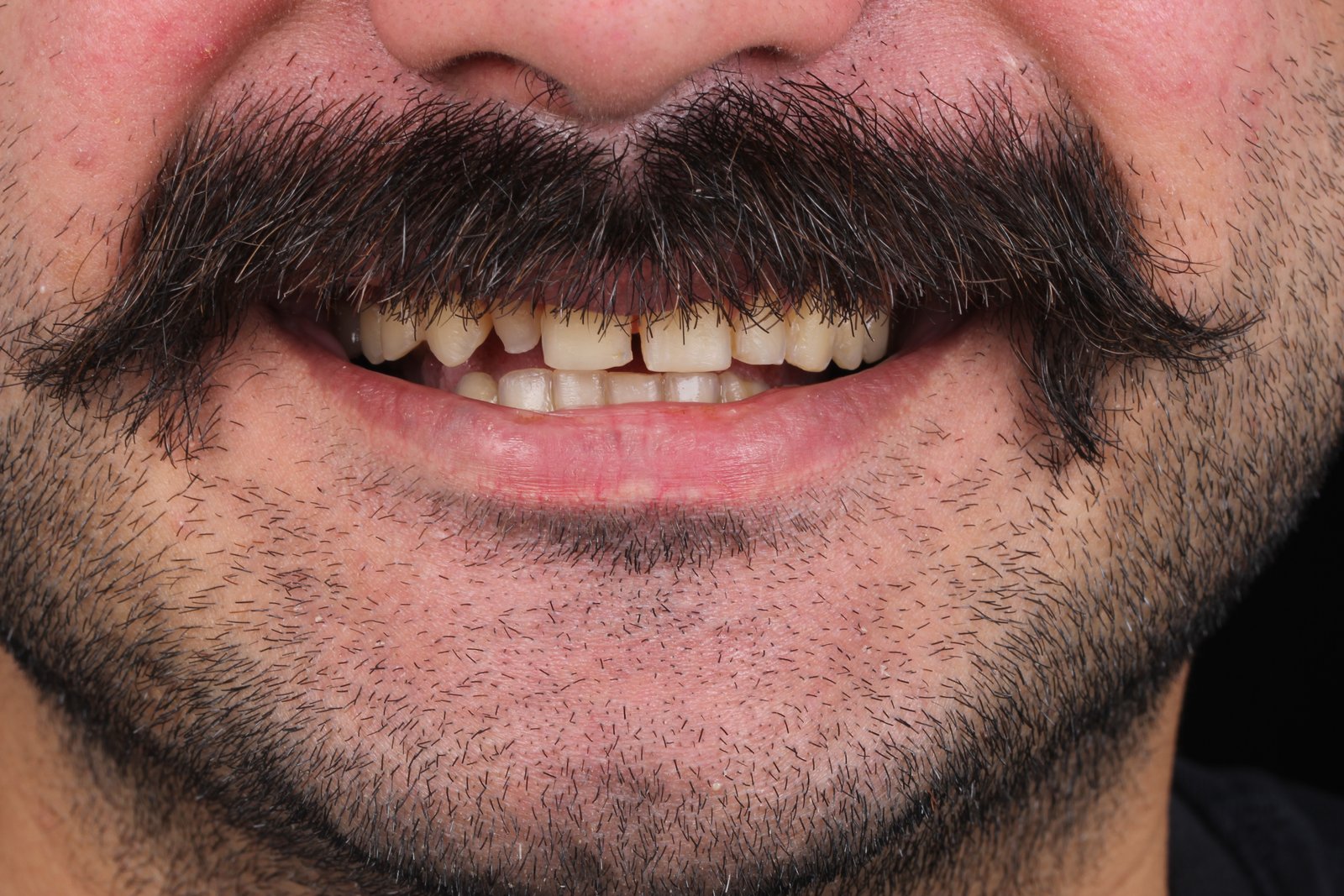 Before treatment