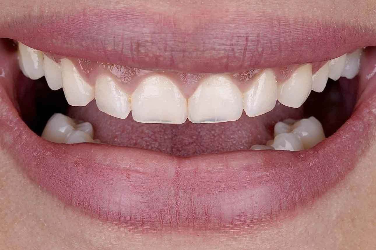 Before treatment